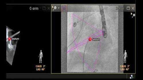 View XRay image with markers for context and guidance