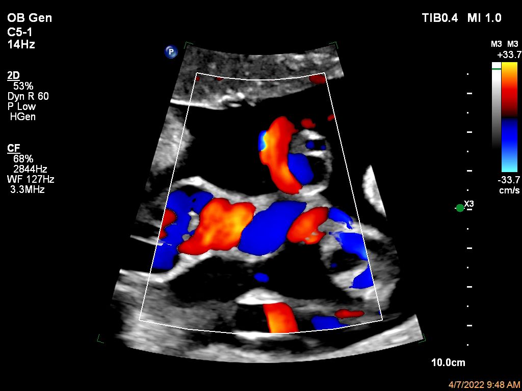 Umbilical Cord Color Flow with Flow Viewer