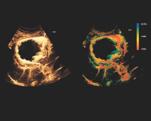 SuperRes MVI & TOA Clinical Image reduce artifacts