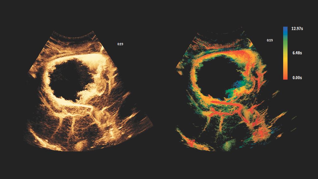 Liver lesion with Super Resolution MVI and Time of Arrival