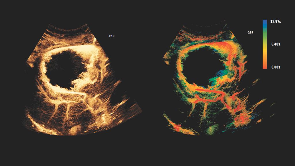 Liver Hemangioma