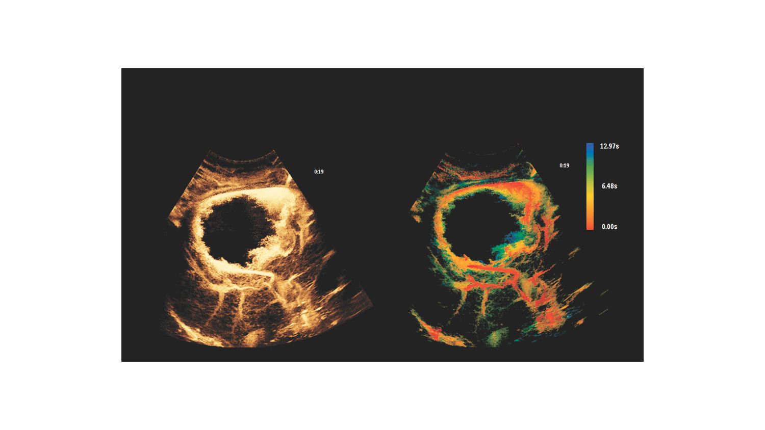 Liver Hemangioma scanned on Philips Epiq Elite CEUS