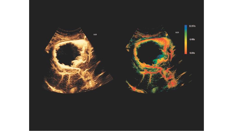 Liver Hemangioma scanned on Philips Epiq Elite CEUS