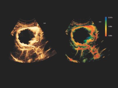 Liver CEUS Hemangioma