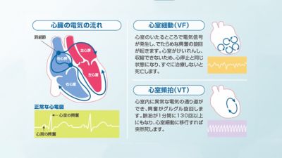 心臓の電気的活動と不整脈の図