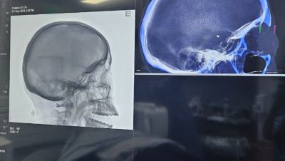 Vistas de imágenes multimodales utilizadas para planificar un procedimiento neurointervencionista con Philips XperGuide