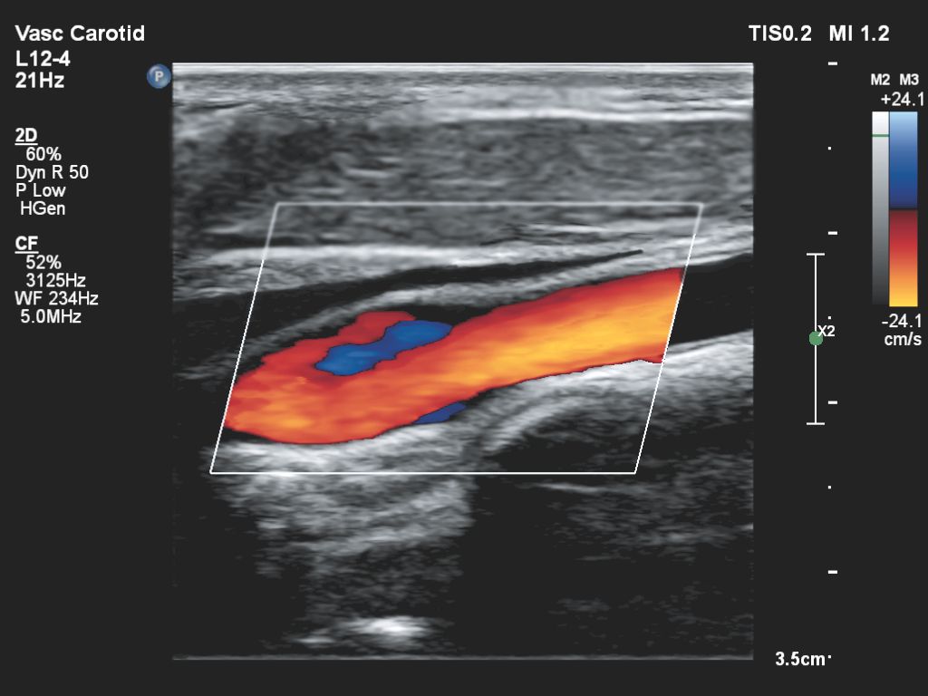 Affiniti 30 ultrasound clinical image vascular carotid