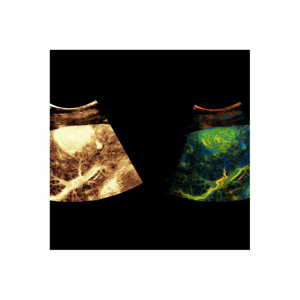 Super Res MVI Pro* clinical image showing a liver lesion