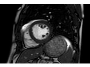 CINE FreeBreathing MR Clinical Applications
