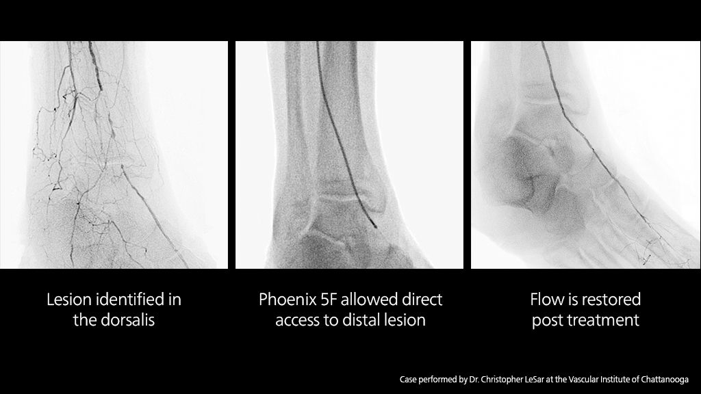 Low-profile system for distal lesion vessel access [10,11]*​