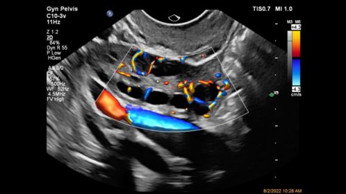 C10-3v Ovarian Perfusion with Flow Viewer