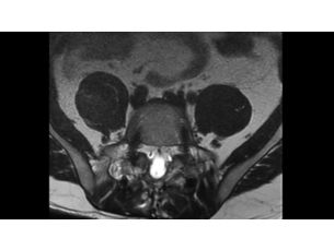 O-MAR XD - Spine MR Clinical application