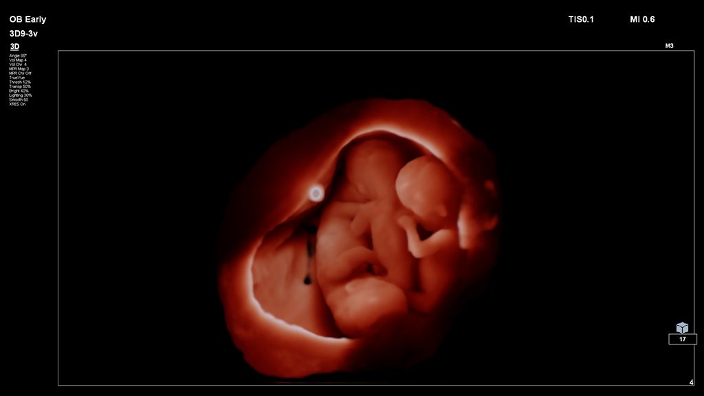 3D image of triplets with TrueVue Light Source and 3D9-3v transducer
