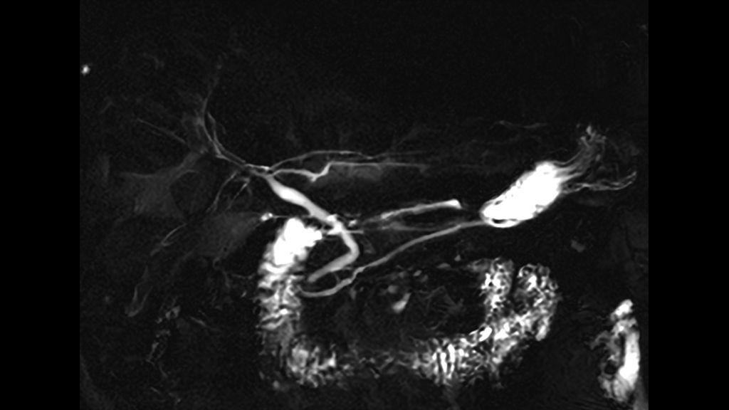 Coronal Single Shot MRCP