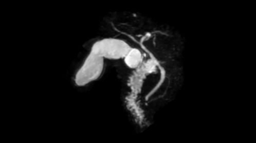 3D MRCP (MIP)