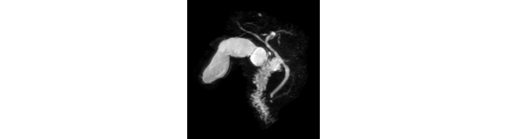3D MRCP (MIP)