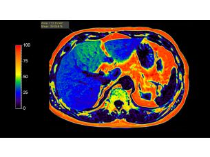 mDIXON Quant MR clinical application