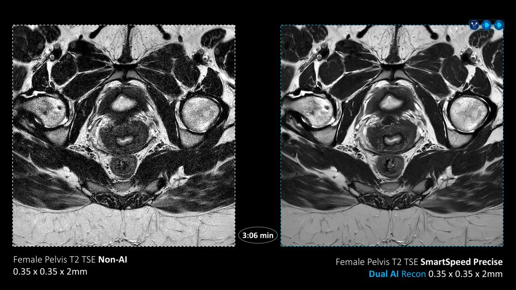 SmartSpeed Precise Pelvis comparison with Ingenia Evolution