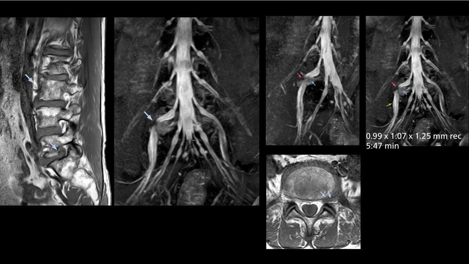 MRI neurography of right L5 radiculopathy