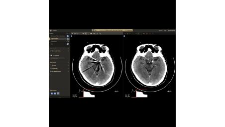 Metal artifact reduction algorithm for CBCT ​​