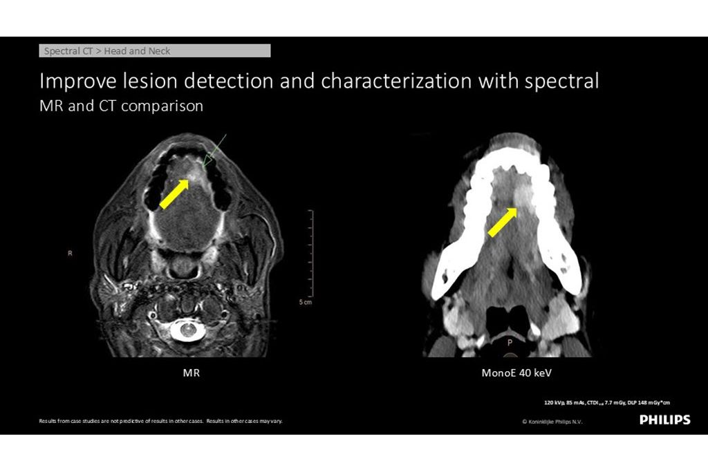 Spectral CT – Head and Neck