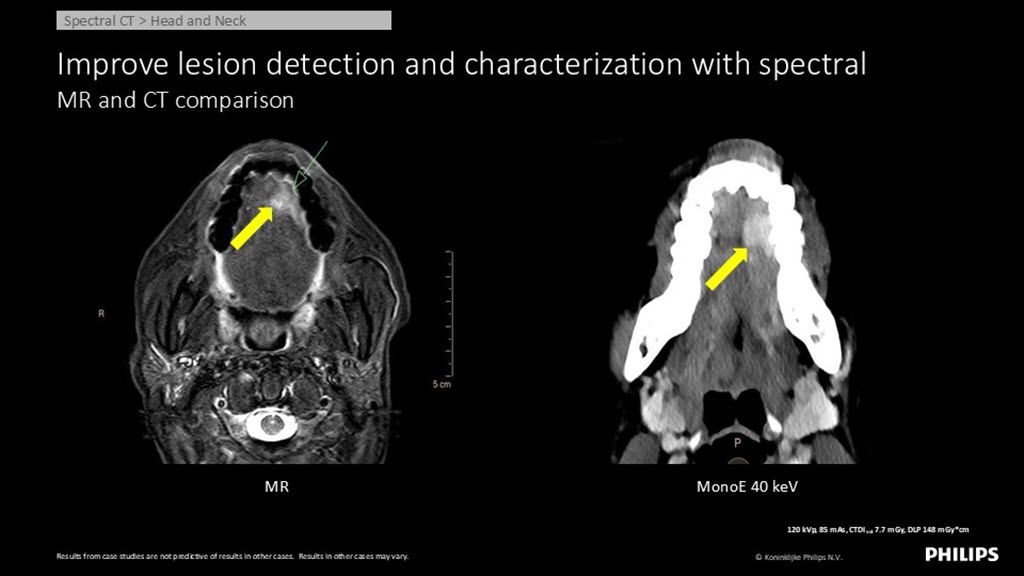 Spectral CT – Head and Neck