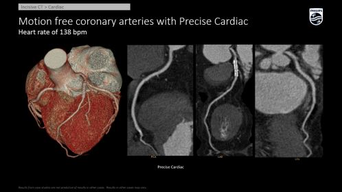 Incisive CT Precise Cardiac - 138 bpm