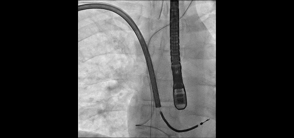 TightRail rotating mechanical
dilator sheath