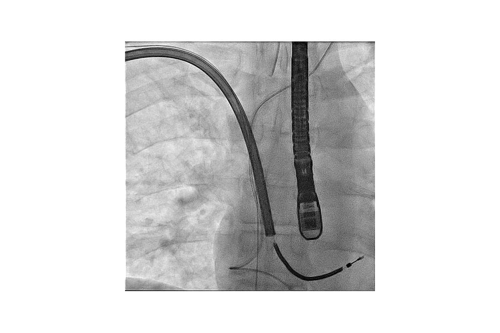 TightRail rotating mechanical
dilator sheath