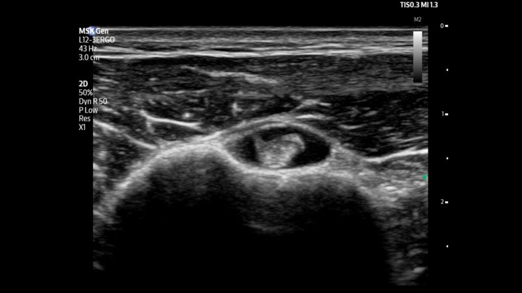 Bicep tendon shown using L12-3ERGO transducer on Flash 5100 POC.