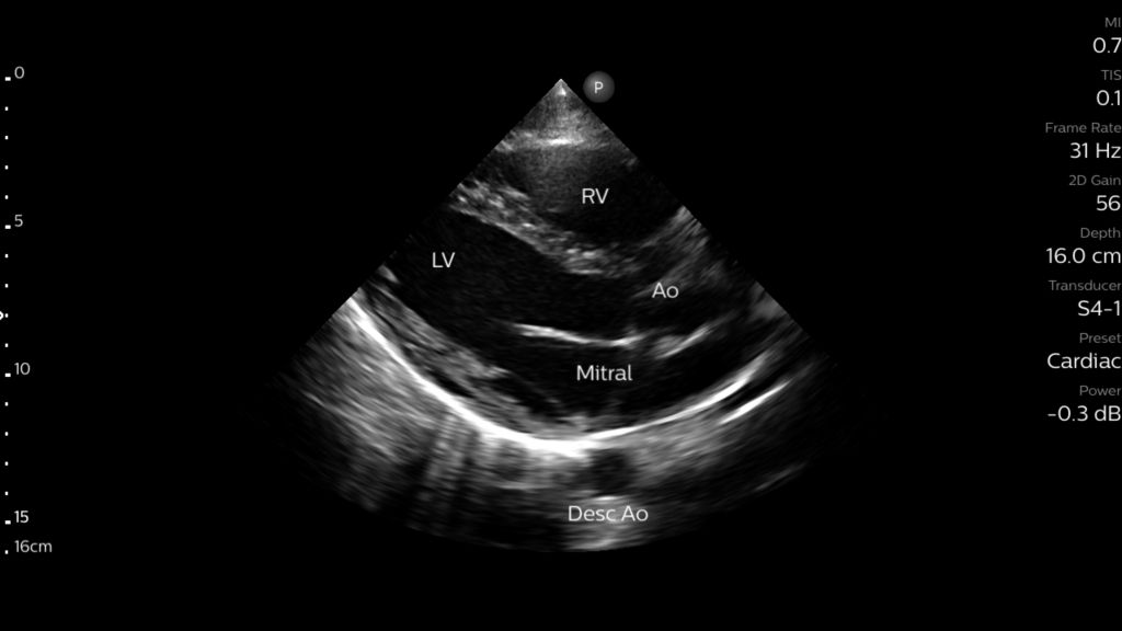 PLAX view of the heart shown with annotations using S4-1 transducer.