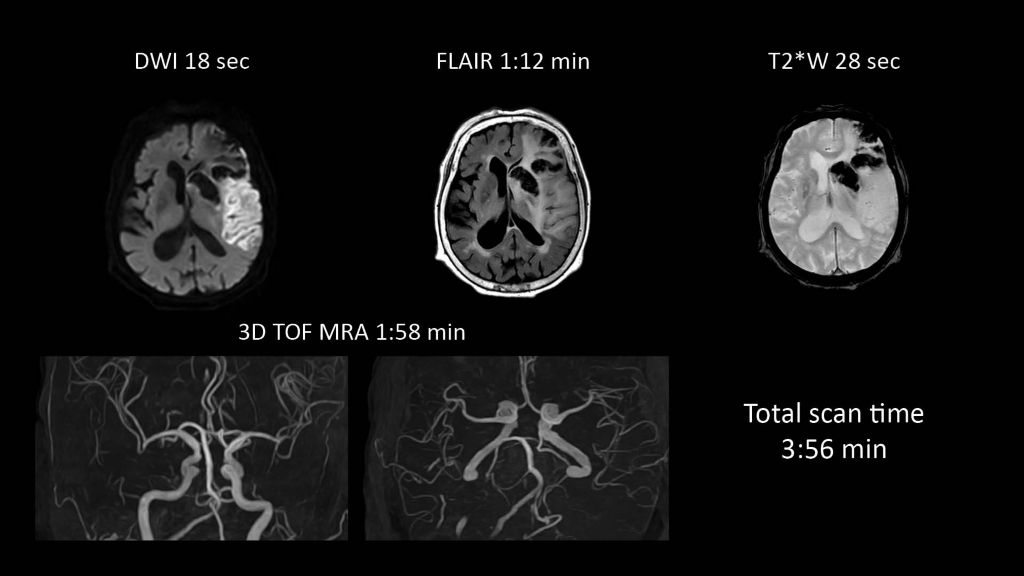 Acute head imaging using SmartSpeed. Total imaging time 3:56 min