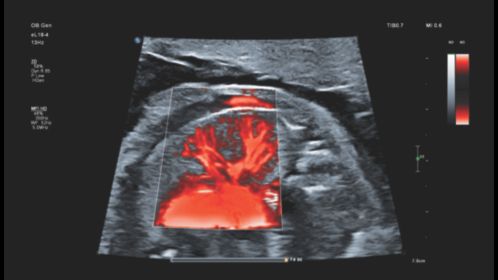 Fetal lung perfusion with MFI HD using eL18-4 transducer