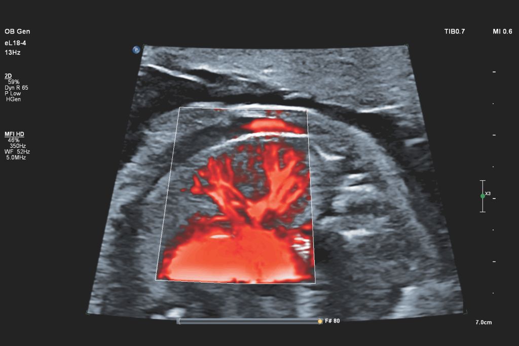 Fetal lung perfusion with MFI HD using eL18-4 transducer