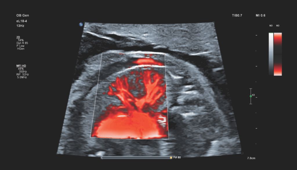 Fetal lung perfusion with MFI HD using eL18-4 transducer