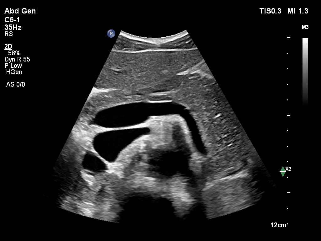 Pancreas in 2D using C5-1 transducer