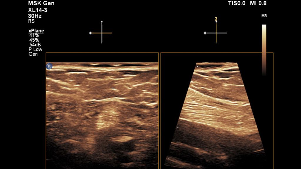 Tibial Nerve