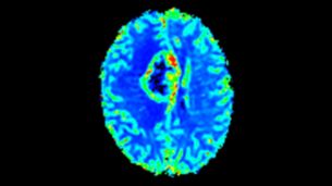 T2* Perfusion 