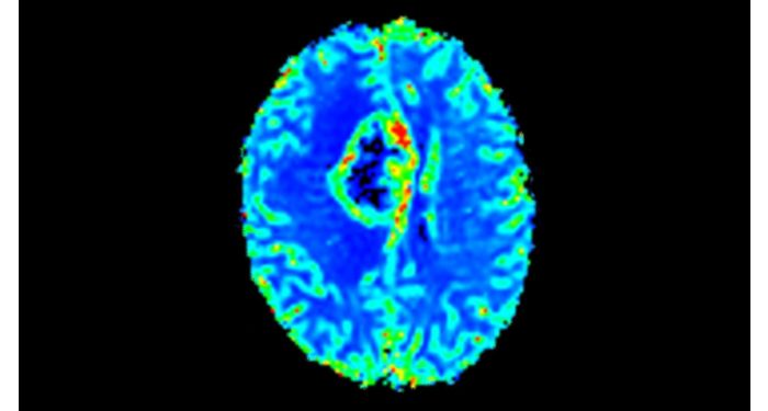 T2* Perfusion MR Clinical application | Philips