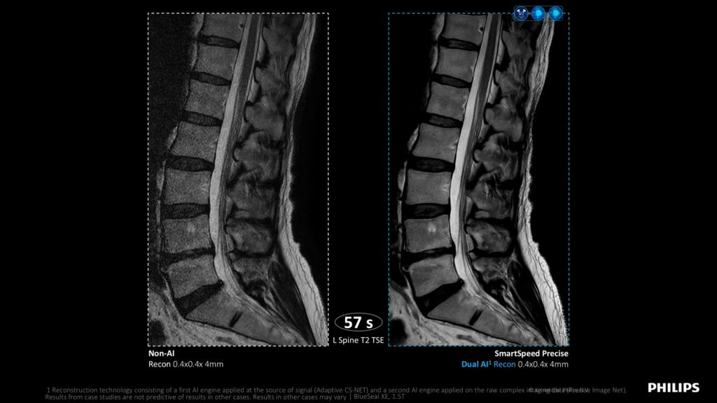 SmartSpeed Precise speed comparison - Spine