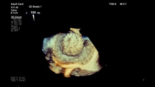 Live 3D TEE Zoom of LAA Occluder