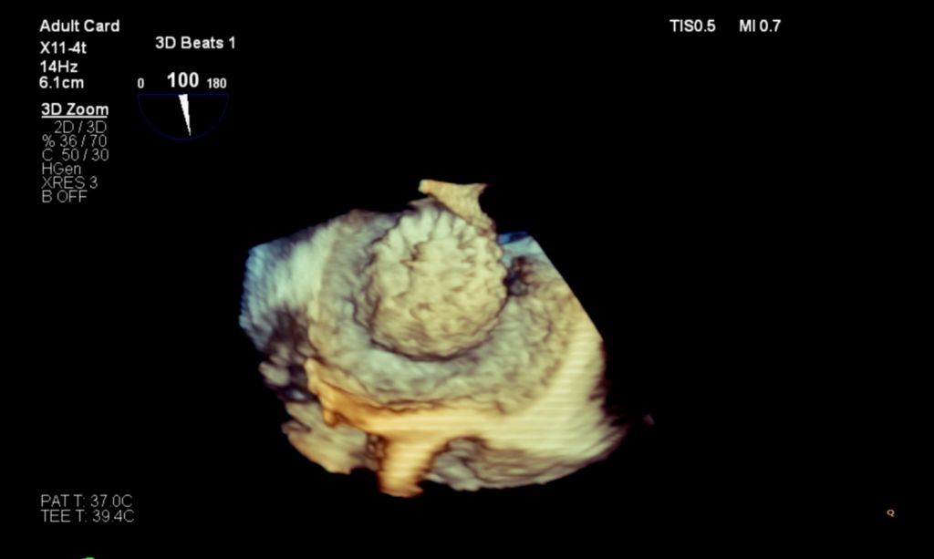 Live 3D TEE Zoom of LAA Occluder