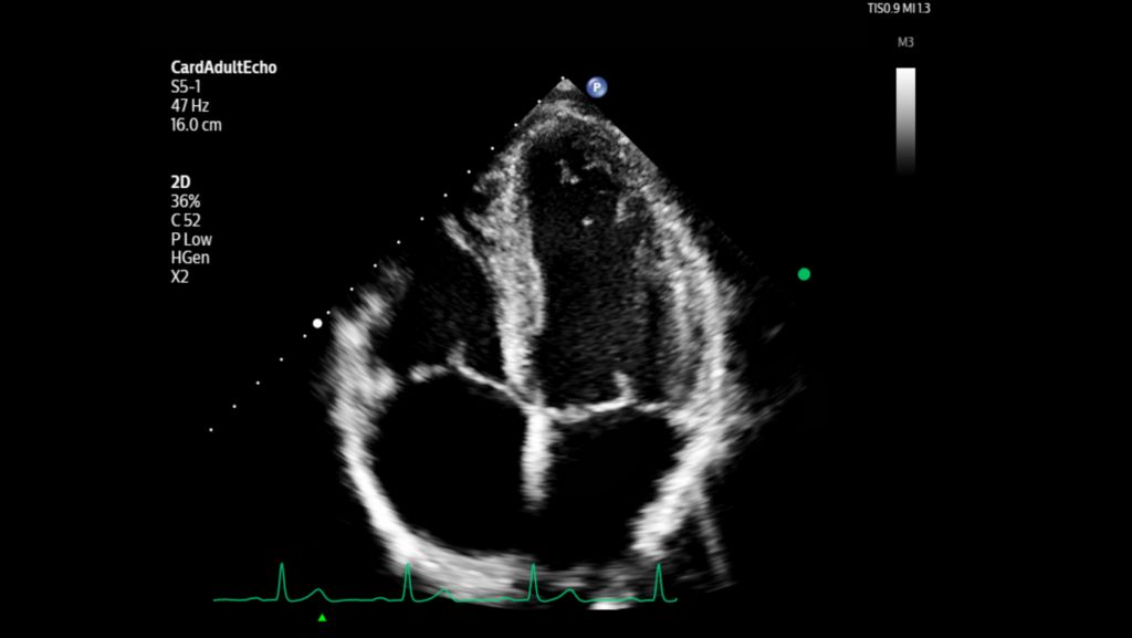 Adult echo apical 4ch using S5-1 transducer.
