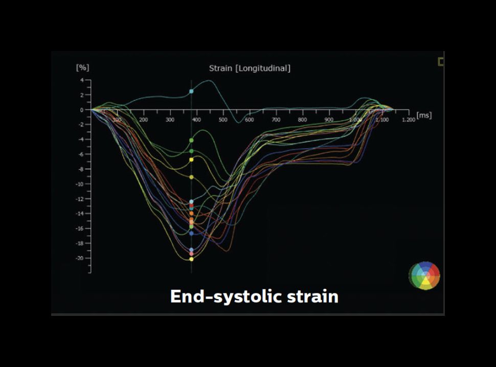 AutoStrain Clinical image showing segmental strain curves and strain values – end systolic strain