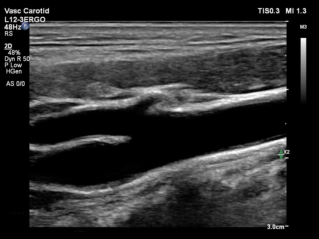 L12-3ERGO Vascular Carotid