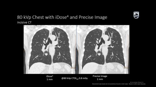 Incisive CT_C Thorax faible dose_Image clinique