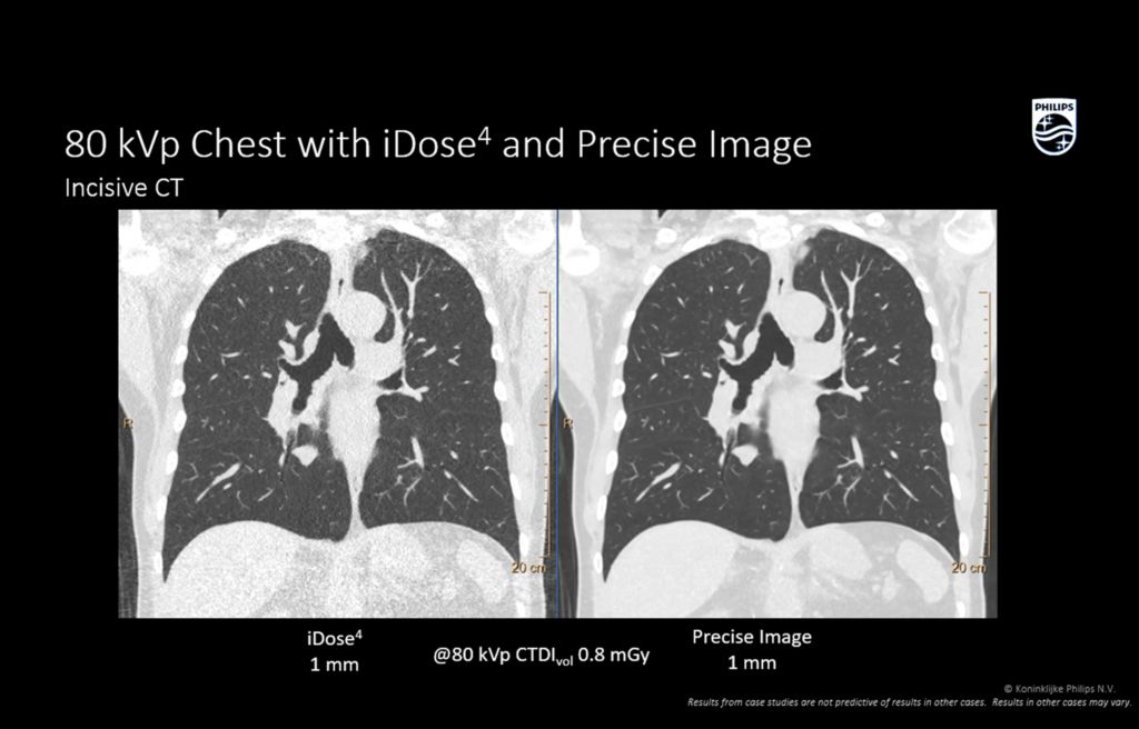 Incisive CT_C Низькодозна КТ органів грудної клітки_Клінічне зображення