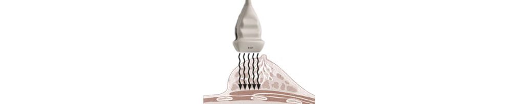 Tissue aberration correction