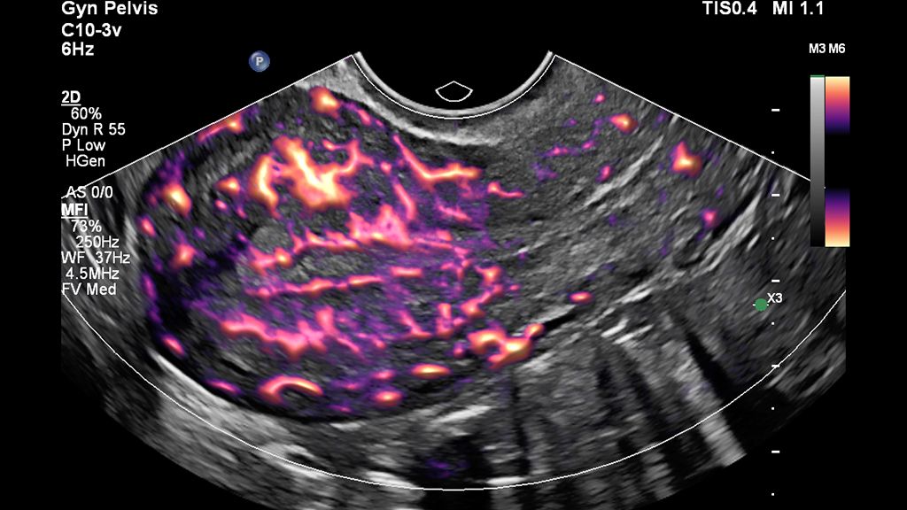 Clinical image of uterus obtained with MicroFlow imaging (MFI) and Flow Viewer
