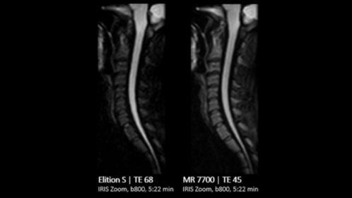 C-Spine Comparison IRIS ZOOM b800